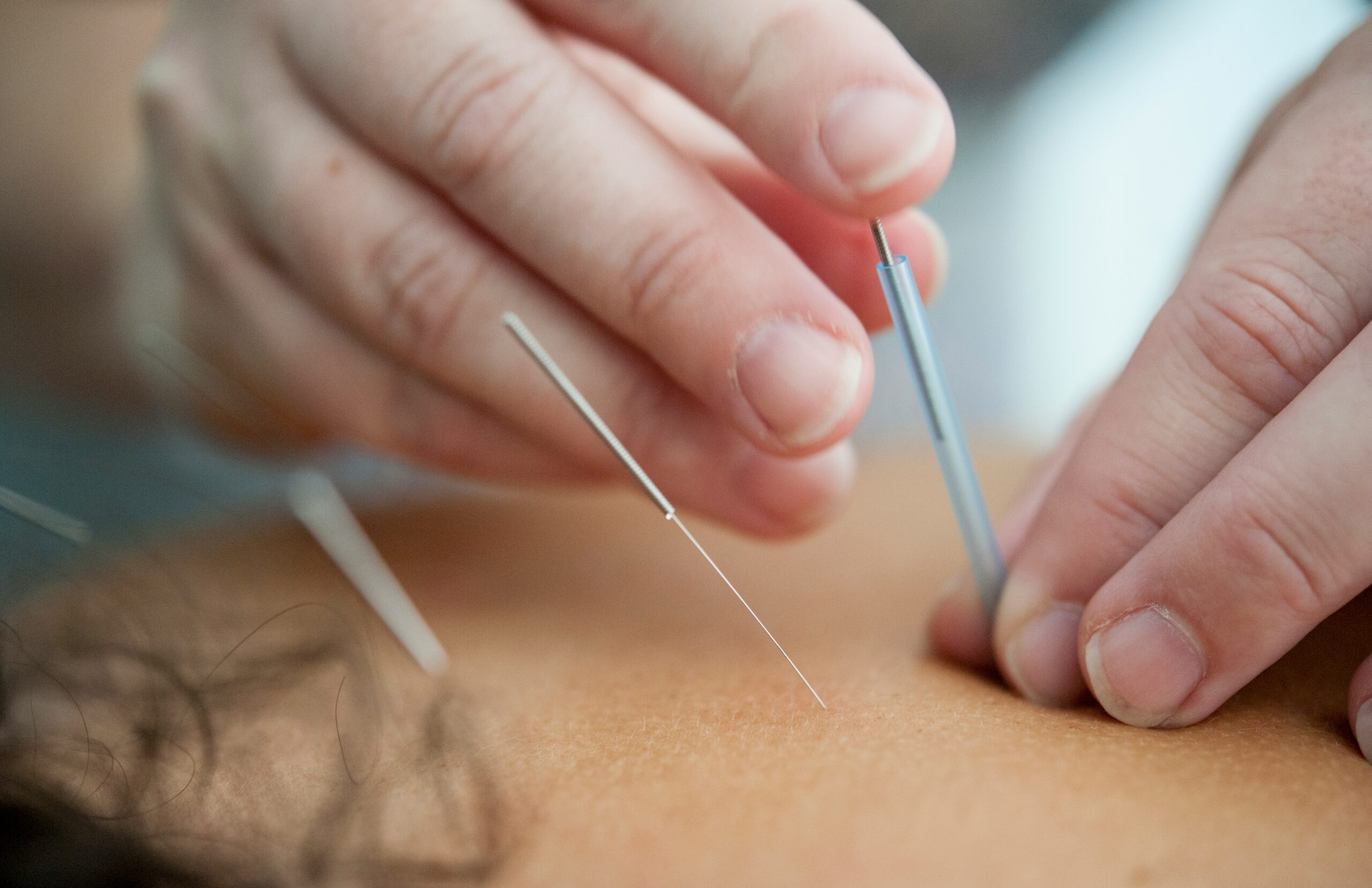 Unlocking the Benefits of Acupuncture for Your Health